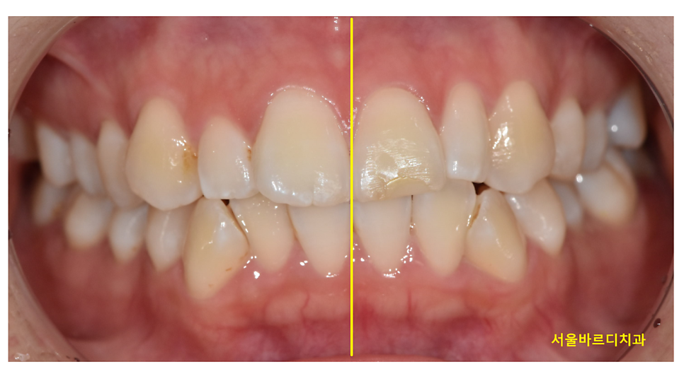 치아 중심선 안맞을 때 걱정스러우신 분들이라면? 관련 이미지 1