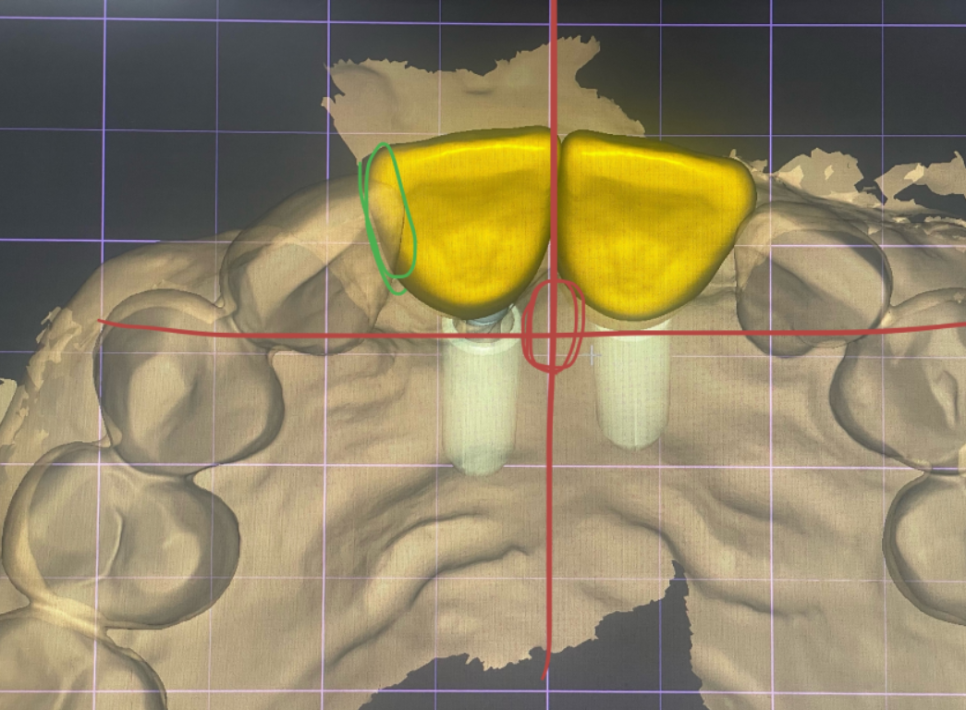 대문니 빠짐, 앞니 빠졌을 때 브릿지와 임플란트 중 나에게 맞는 선택은? 관련 이미지 16