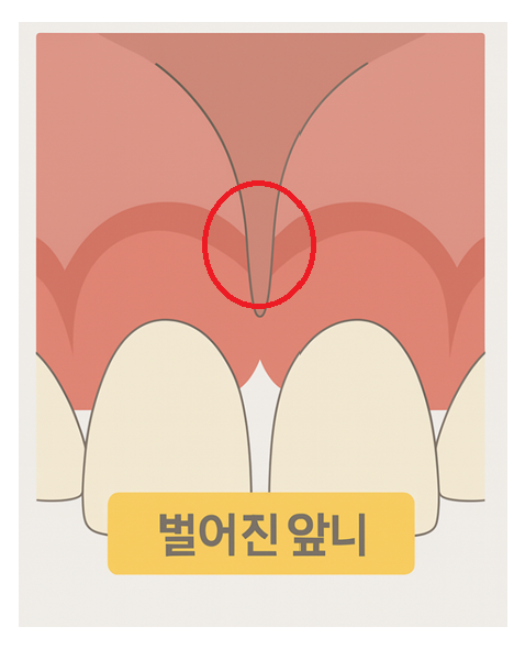 깨지고 벌어진 앞니 사이 레진으로 공간 재분배하였습니다. 관련 이미지 3