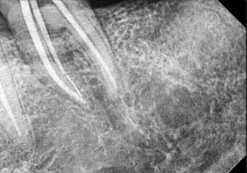 상일역 치과, 오래된 금니 빠짐, 같은 증상으로 내원했지만 전혀 다른 결과, 그 차이는? 관련 이미지 16