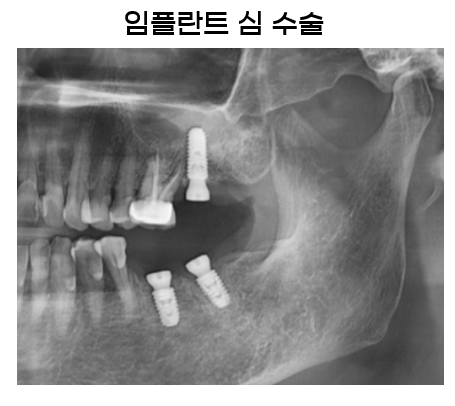 상일동 치과 임플란트 심 박는 것이 무엇인가요? 관련 이미지 2