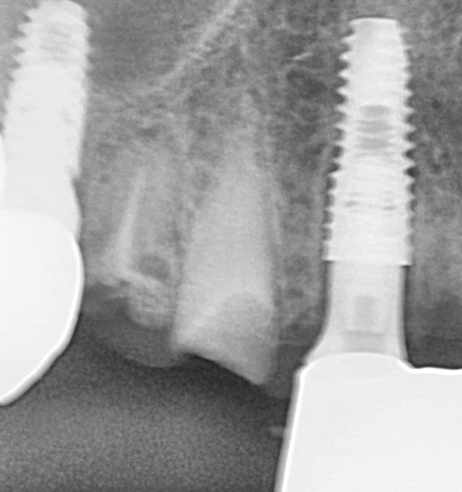 상일동 임플란트 심한 충치로 인한 치아 부러짐 해결한 사례 관련 이미지 12