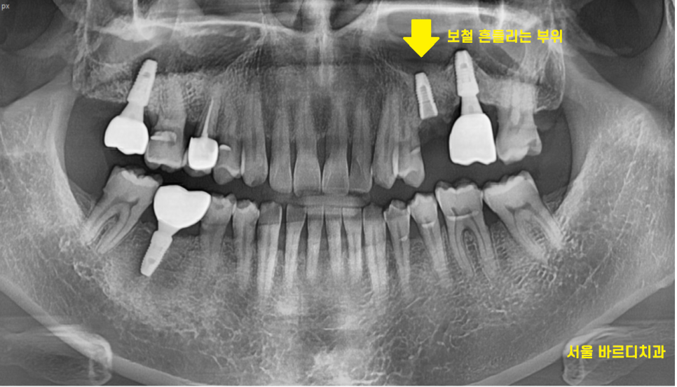 길동 치과 임플란트 보철 흔들림 교체 해야할 경우 관련 이미지 2