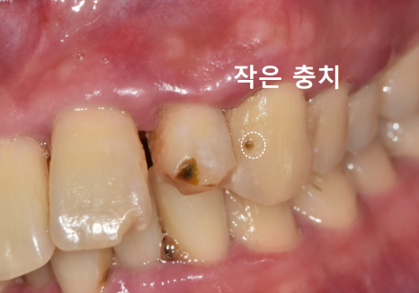 강동구 앞니 충치, 누구는 레진이고 누구는 임플란트인 관련 이미지 7