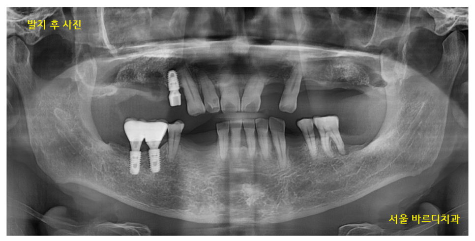 하남시청치과 디지털 임플란트를 고집하는 이유 관련 이미지 7