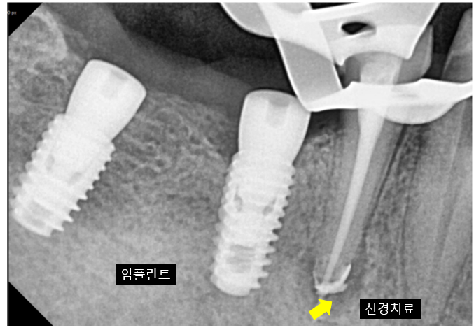 치아 닿기만 해도 아픔 원인은?? 해결은 이렇게 했습니다 관련 이미지 8