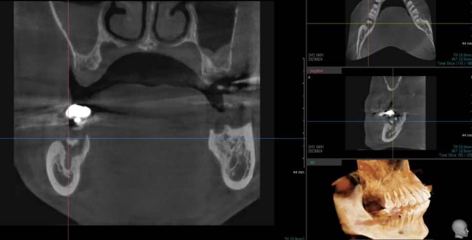 이 흔들림으로 발치 후 뼈이식 진행한 케이스 관련 이미지 4
