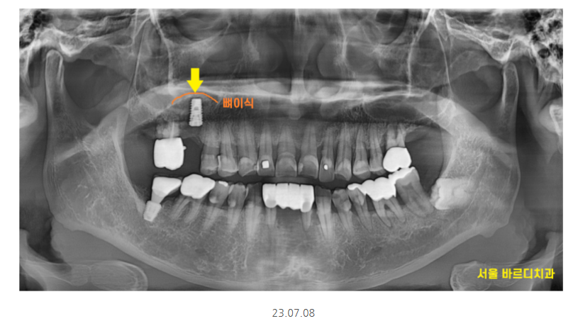 강일동 치과추천 어금니 시림 방치하다 발치하고 임플란트 하신 사연 관련 이미지 6