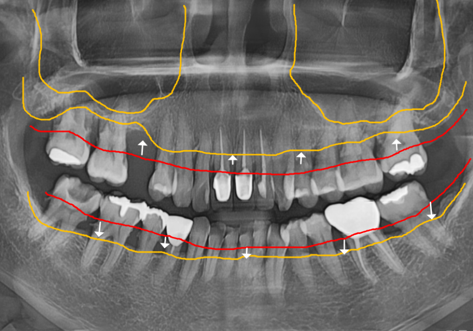 고덕동 스케일링 미루다 앞니 어금니 다 뽑고 임플란트 했습니다. 관련 이미지 14