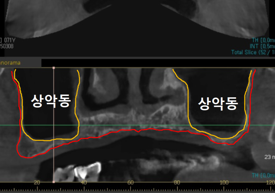 뼈가 없어서 안 된다구요? 70대 당뇨 무치악 환자분의 전체 임플란트 사례 관련 이미지 4