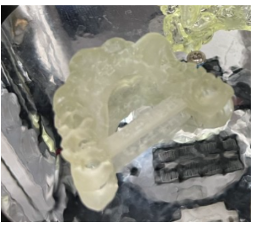 하남시청치과 내비게이션 임플란트 뭐가 좋아요?? 관련 이미지 5