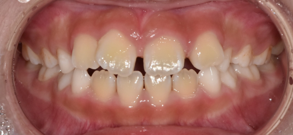 어린이 덧니 교정 걱정되신다면 이 글 꼭 보세요! 적정 시기는? 관련 이미지 2