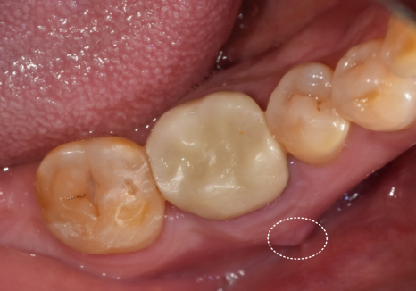 강동구 잇몸 여드름, 이런 상태라면 절대 겉에만 짜는 치료 하지 마세요. 관련 이미지 4