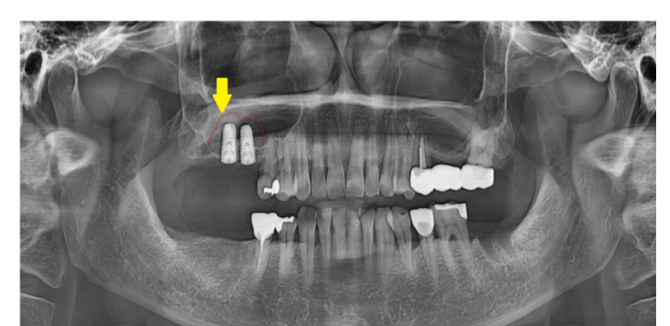 상일동역 치과 상악동 수술 후 코피 이렇게 대처하세요! 관련 이미지 5