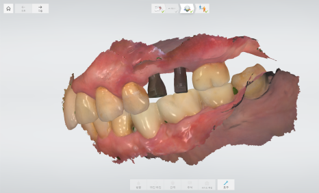 상일동 임플란트 상악동 거상술을 동반한 수술 증례 관련 이미지 11
