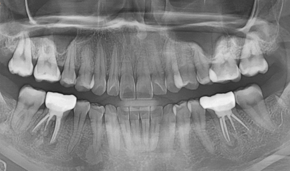 고덕동 20대 임플란트, 시기 놓치면 비용 2배 이상 듭니다. 관련 이미지 12