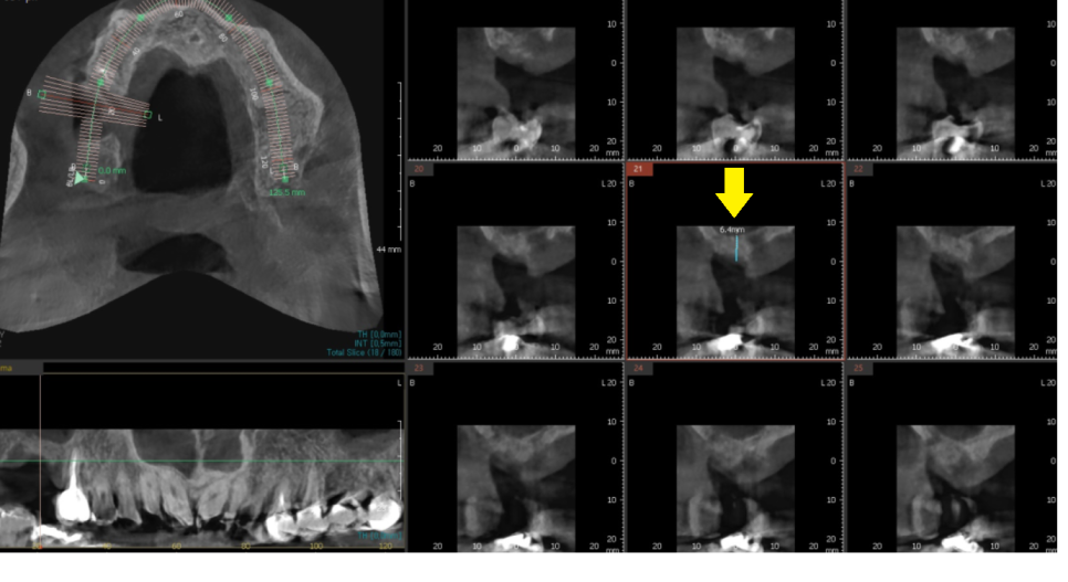 명일역 근처 치과 치아 뿌리 염증이 생겨서 고생하신 사연 관련 이미지 6