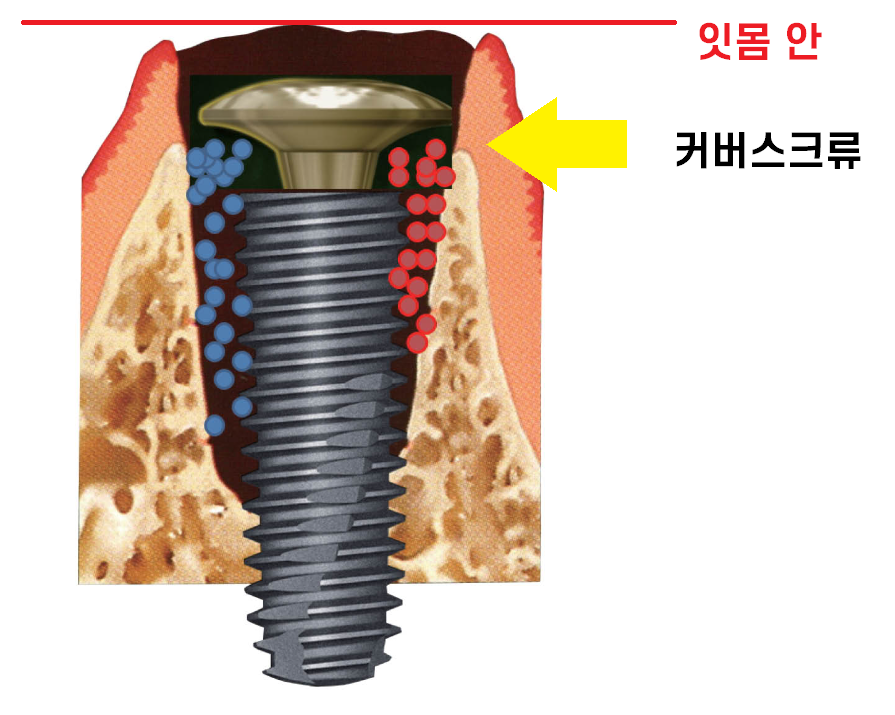 임플란트 2차 수술 과정 아직도 안끝났어요? 죄송합니다!! 관련 이미지 5