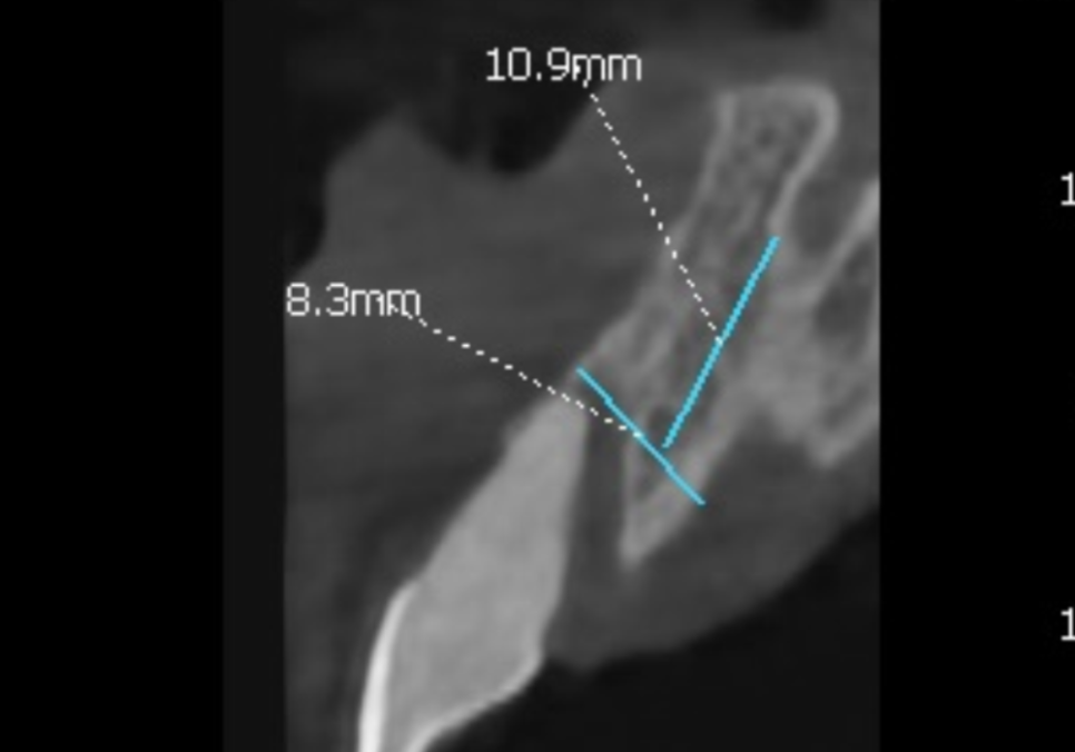 앞니 길어짐, 위 앞니가 점점 내려온다면? 관련 이미지 11