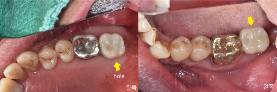 상일동치과 서울바르디치과 무절개 네비게이션 임플란트 치료증례 #3 관련 이미지 14