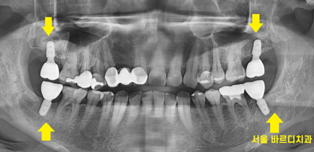 명일동 치과 임플란트 위아래 같이 한꺼번에 할 수 있나요?? 관련 이미지 7