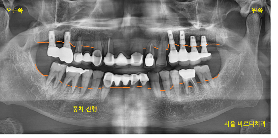 명일역 치과 움직이는 치아 치료 고정할 수 있을까? 관련 이미지 2