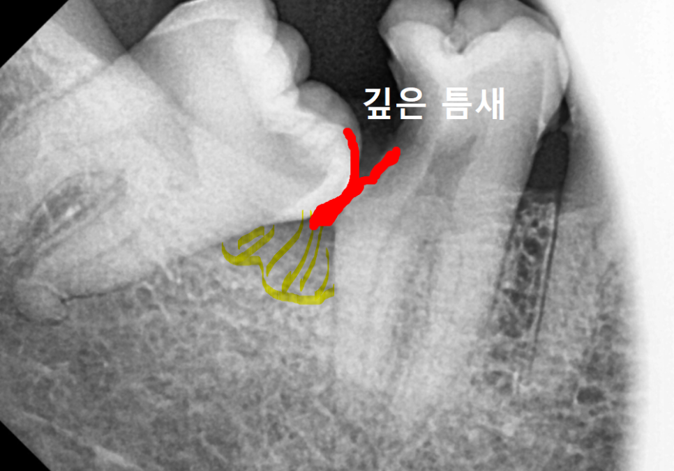 수평 매복 사랑니, 옆으로 누운 사랑니 때문에 멀쩡한 어금니까지 뽑은 사연 관련 이미지 4