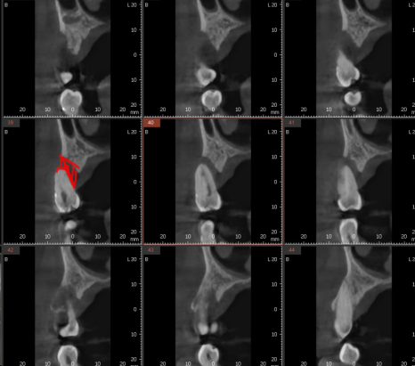상일동역 치과 잇몸 뼈 녹음 임플란트 케이스 관련 이미지 5
