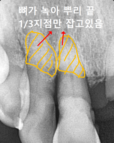 상일동역 치과 앞니 임플란트 기간 때문에 망설이신다면 꼭 보세요. 관련 이미지 4