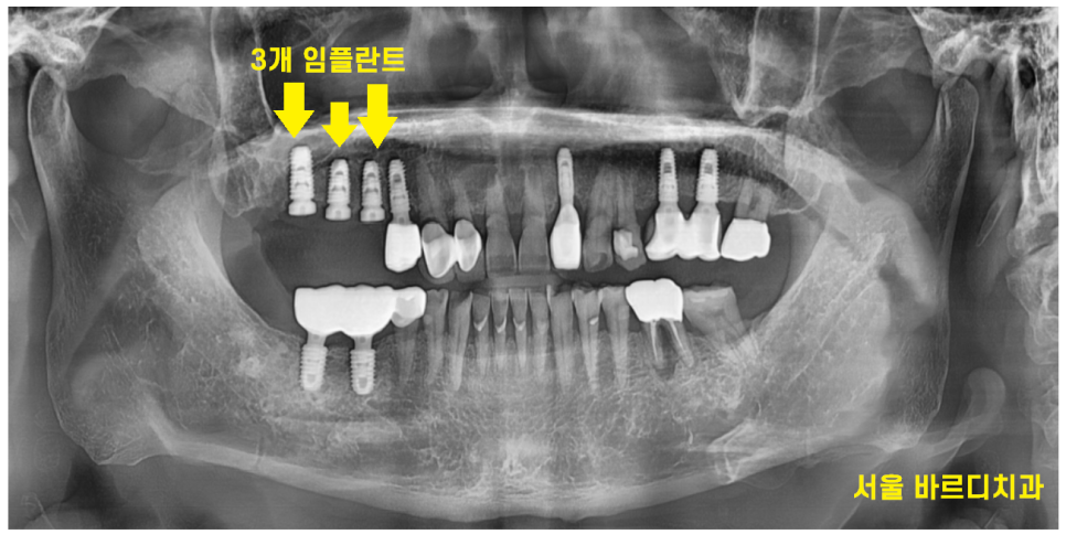 고덕동 치과치료 씌운 치아 문제가 생겼어요 관련 이미지 7