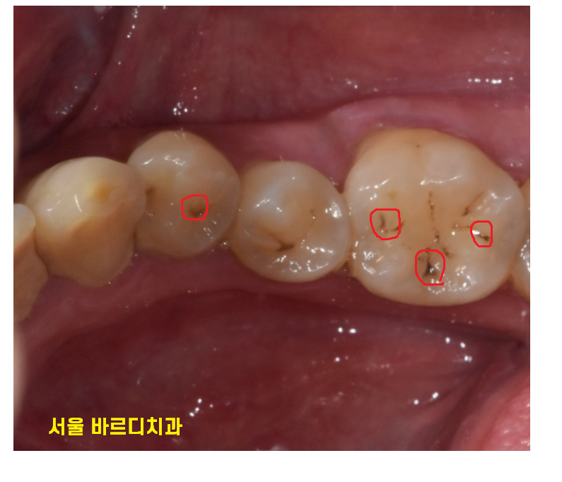 길동 치과 검은 점 충치 검정색이라고 다 치료할 필요는 읎다! 관련 이미지 2