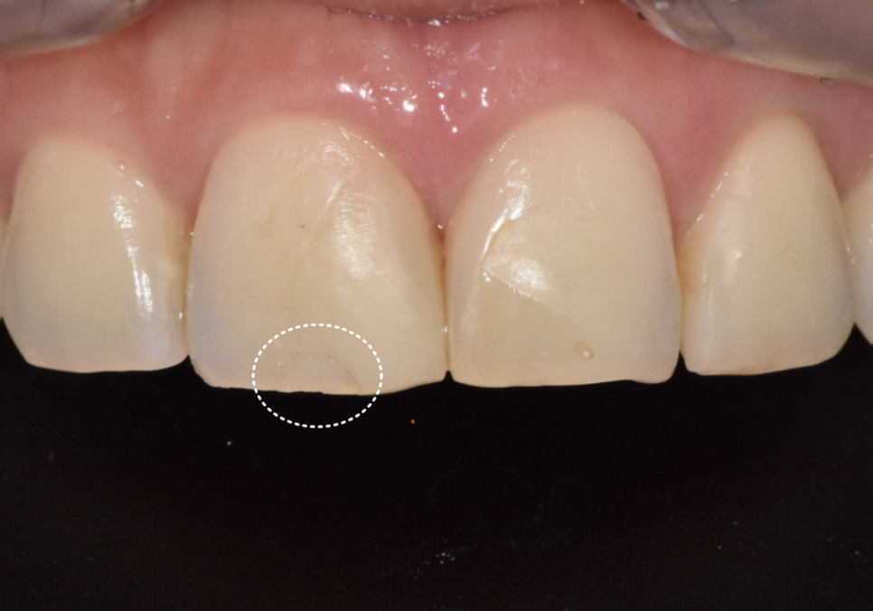 강일역 치과, 검게 보이는 앞니 레진 변색, 무조건 새로 해야 할까요? 관련 이미지 8