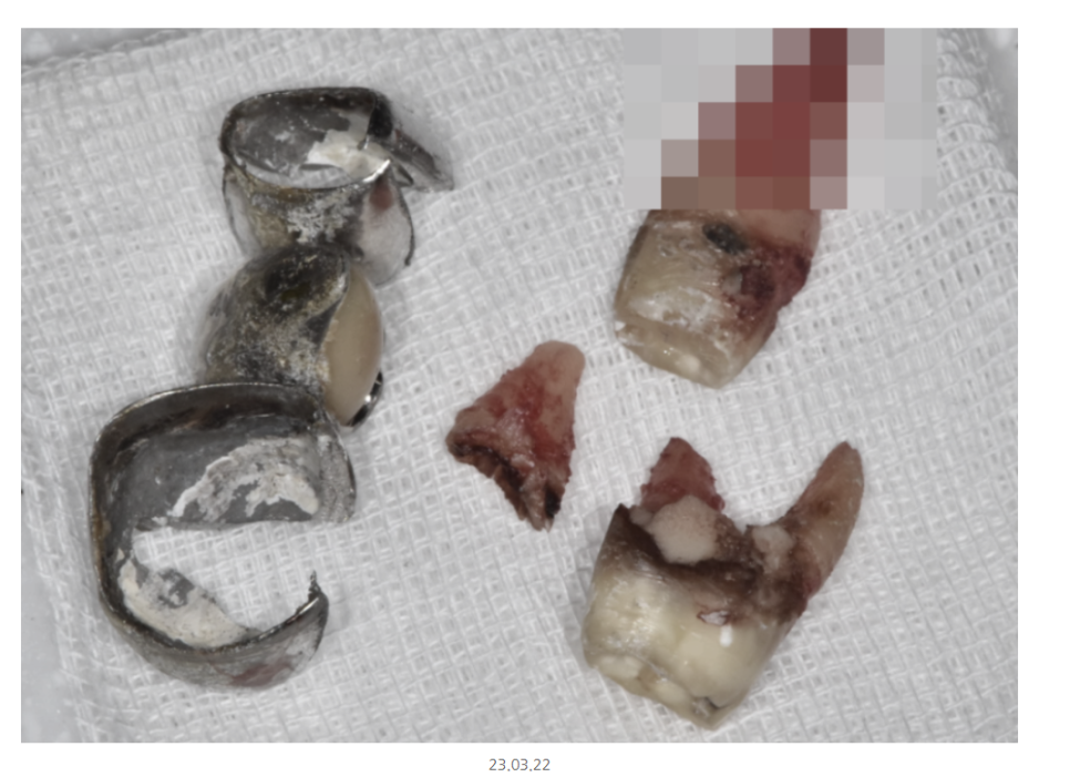 천호동 치과 무절개 임플란트 비교하고 결정하세요 관련 이미지 7