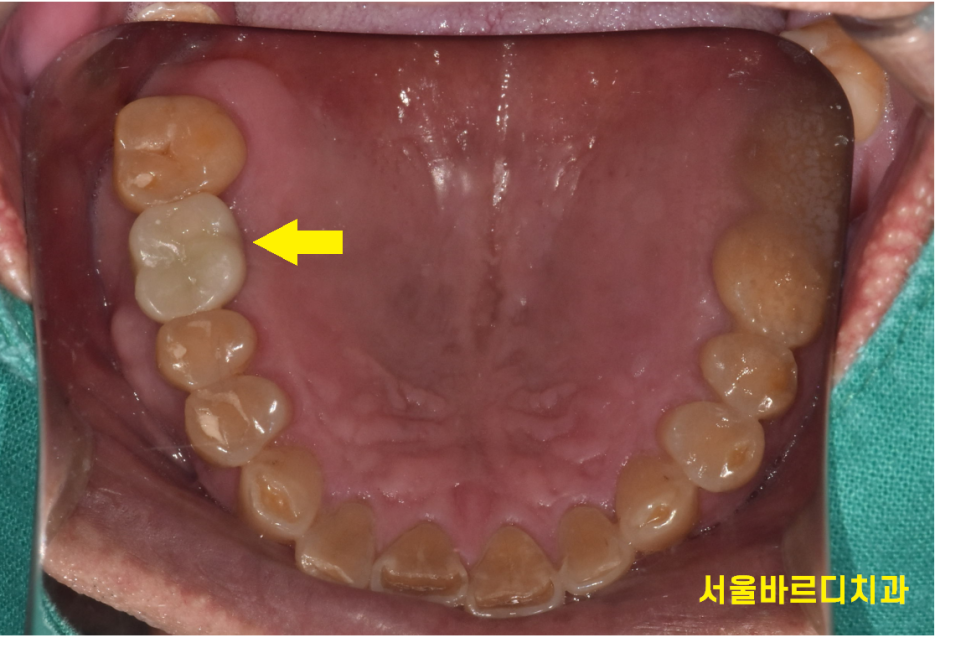 망월동 치과 염증이 심하면 임플란트 바로 못심어요 잇몸뼈 함몰 케이스 관련 이미지 9
