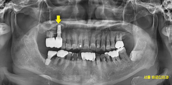 강일동 치과추천 어금니 시림 방치하지마세요 발치하고 임플란트 할 수 있습니다. 관련 이미지 9