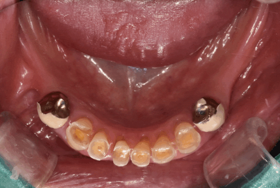 고덕동 20대 임플란트, 시기 놓치면 비용 2배 이상 듭니다. 관련 이미지 1