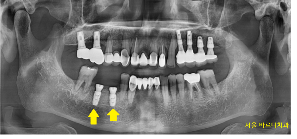 명일역 치과 움직이는 치아 치료 고정할 수 있을까? 관련 이미지 6