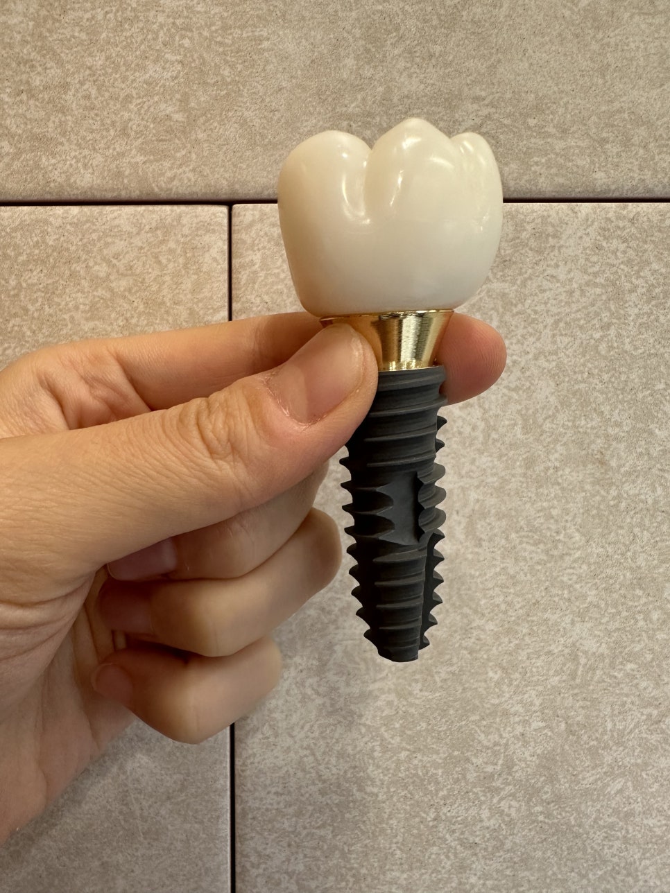 고덕역 근처 치과 임플란트 크라운 크기 크면 다 좋을까요?? 관련 이미지 4