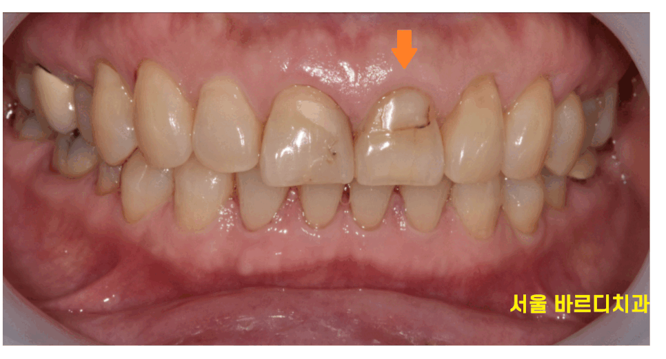 앞니 레진 재치료 변색 부위 연마하면 처음 느낌 그대로 관련 이미지 1