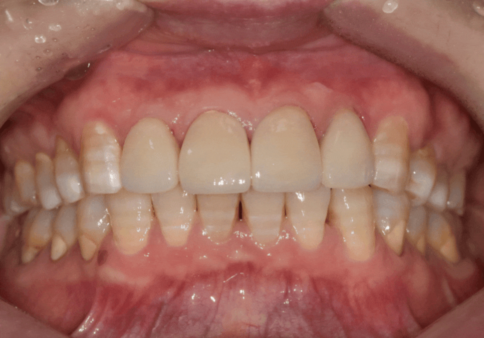 명일동 라미네이트 vs 크라운, 수명을 좌우하는 선택 기준 3가지 관련 이미지 8