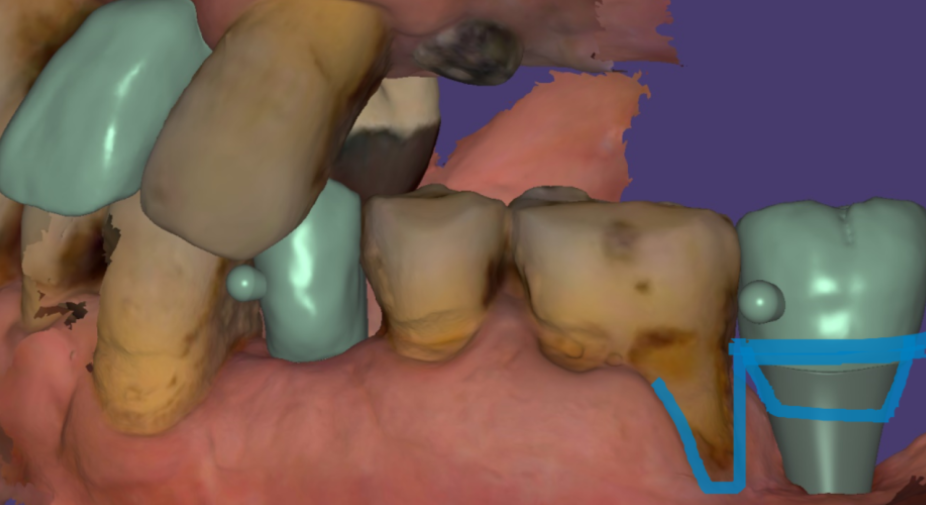 천호동 치과 임플란트 크라운 종류 설명 나갑니다. 관련 이미지 10