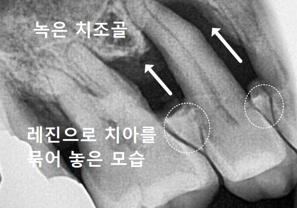 Gangil-dong Molar Implant, "It’s Loose—Can’t You Just Bond It with Resin?" image 5