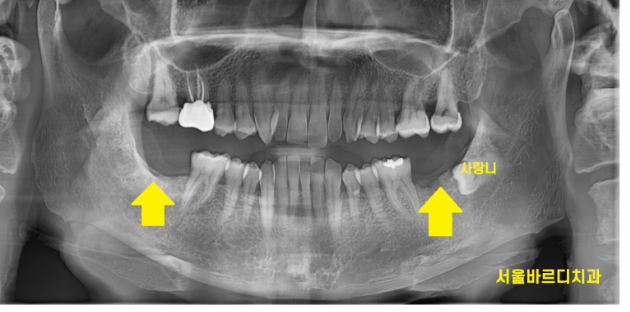 하남시청치과 내비게이션 임플란트 왜 좋다는거죠? 관련 이미지 2