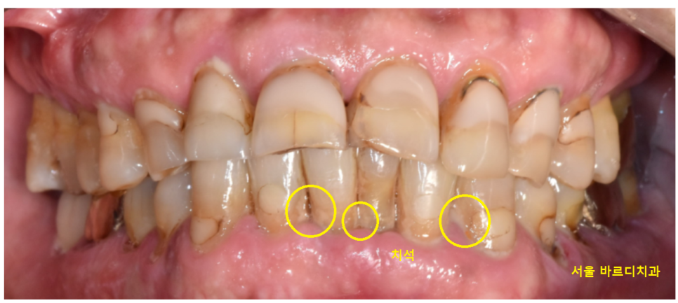 상일동역 스케일링 치과 잇몸치료 받아야하는 이유 필독! 관련 이미지 3