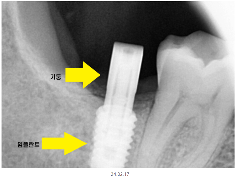 하남시청치과 내비게이션 임플란트 뭐가 좋아요?? 관련 이미지 8