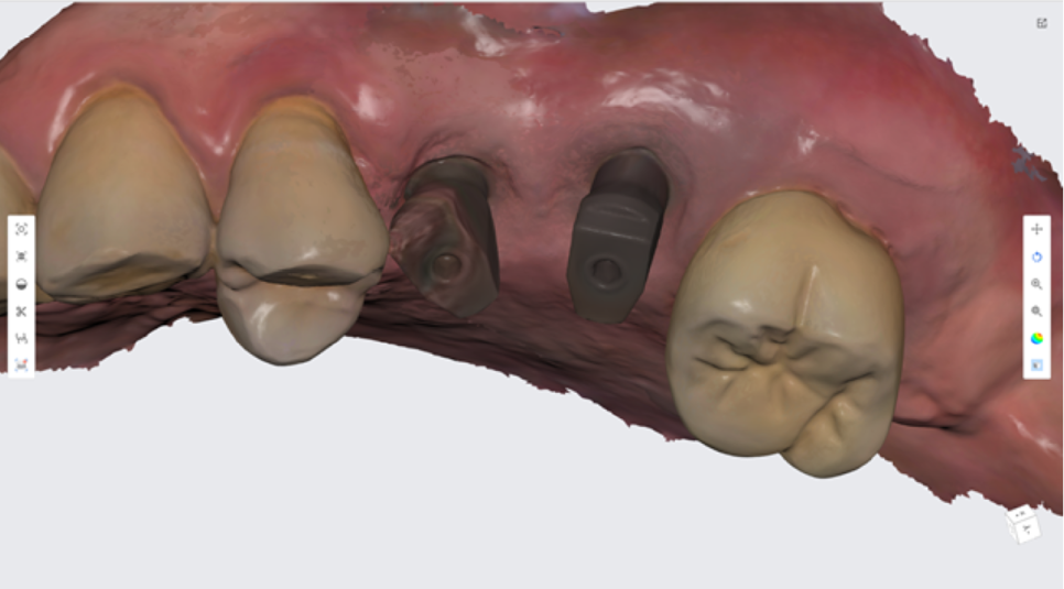 고덕동치과 서울바르디치과 전치부 및 구치부 임플란트 치료증례 #9 관련 이미지 33
