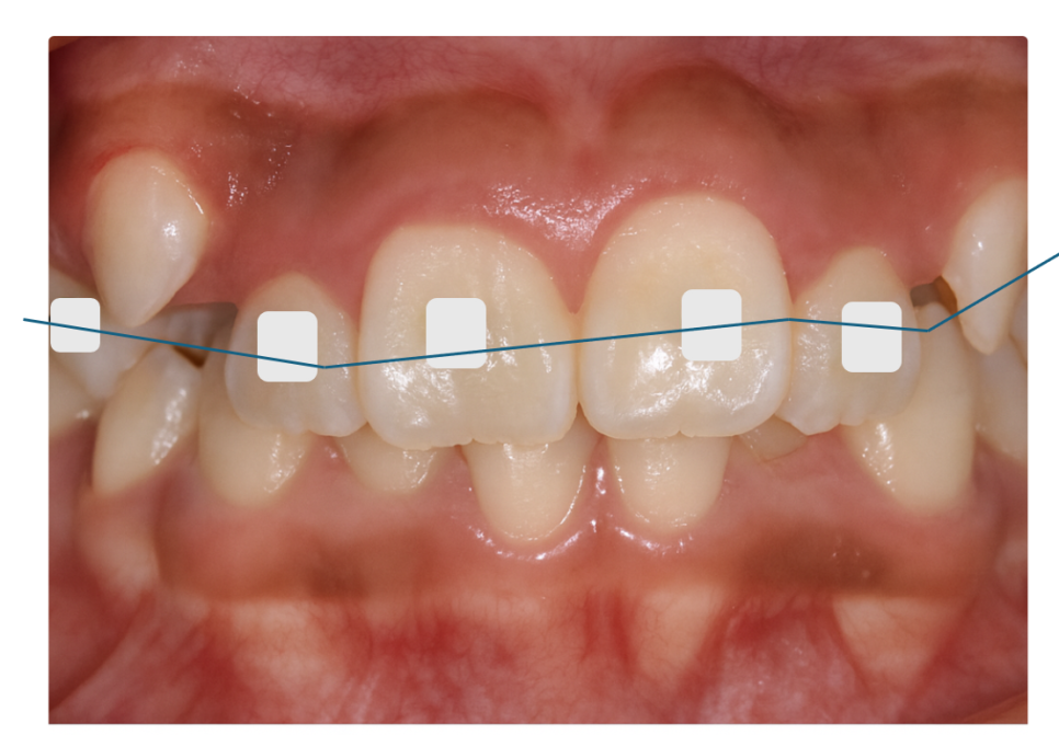 Separately or All at Once for Braces? Click Here if You’re Curious image 6