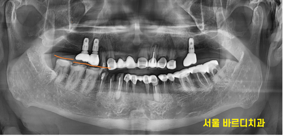 하남 미사 치과 치아 방치하다 올라옴 케이스 보여드립니다. 관련 이미지 2