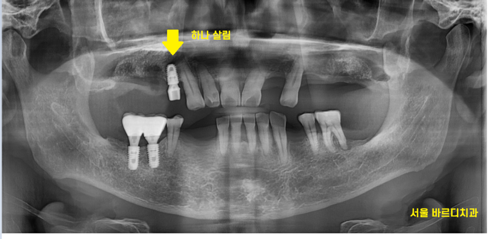 상일동역 근처 치과 타원 임플란트 제거 후 재식립 케이스 관련 이미지 6