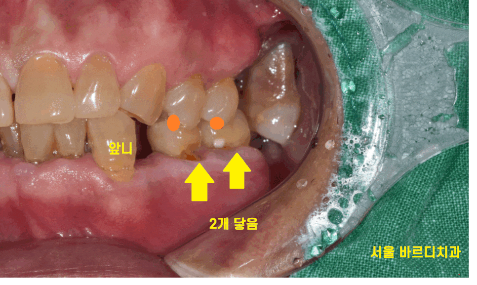 망월동 치과 어금니 빠짐 임플란트 대안이 될 수 있습니다. 관련 이미지 1